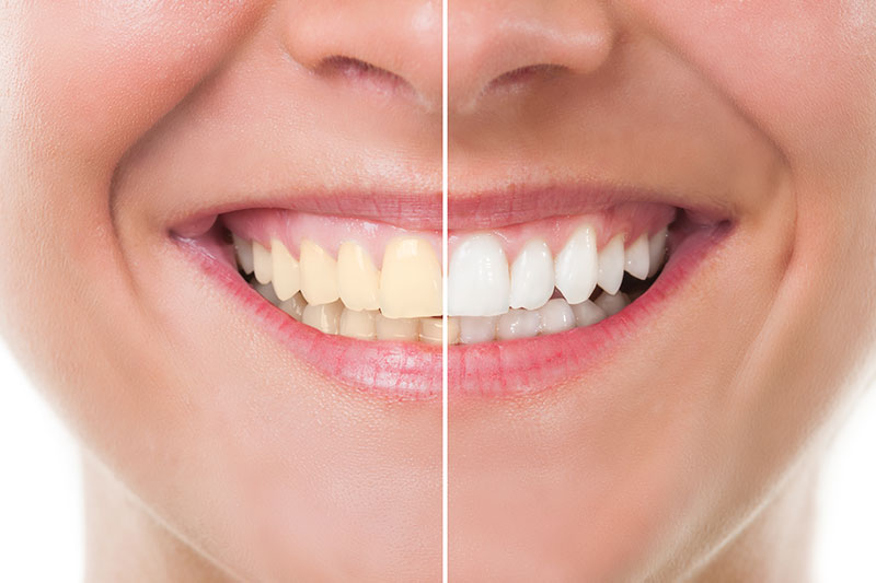 Person smiling showing before and after whitening